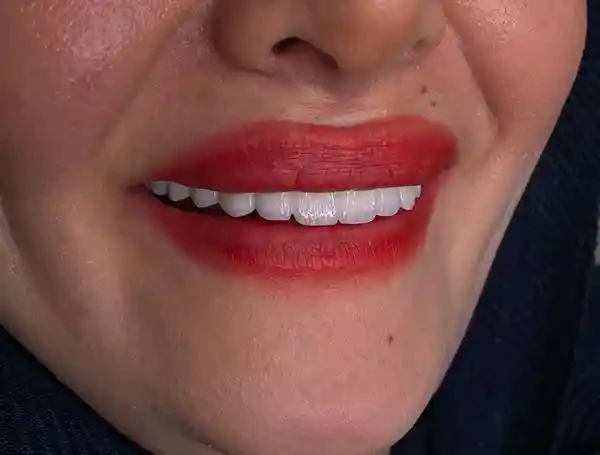 ایمپلنت-ارزان-در-تهران