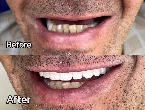 لمینت-بدون-تراش