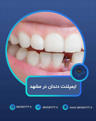 ایمپلنت-دندان-در-مشهد-با-اقساط-بلندمدت-و-شرایط