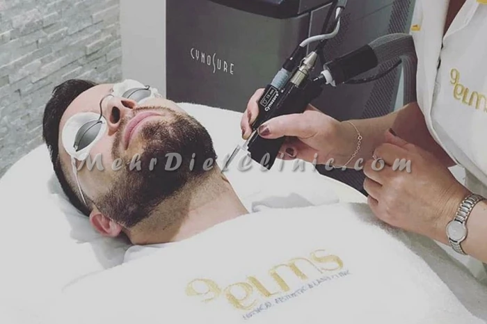 5-روش-لیزر-موهای-زائد-غرب-تهران-(2025)