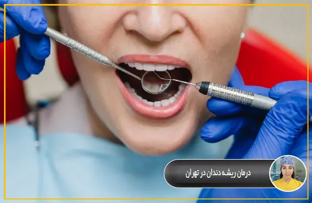 درمان-ریشه-دندان-در-تهران