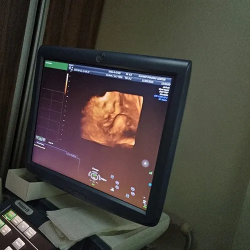 سونوگرافی-داپلر-در-بارداری