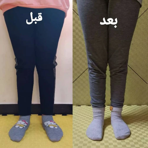 درمان-غیر-جراحی-زانو-ضربدری-پرانتزی-غرب-تهران