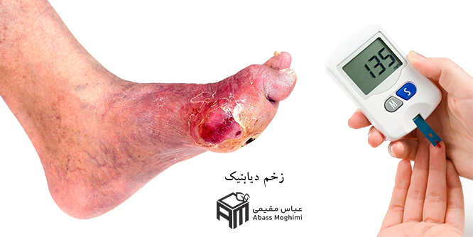 درمان-زخم-دیابتی--کلینیک-بهبودان