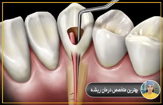 بهترین-متخصص-درمان-ریشه