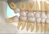 مولاژ-دندان-دائمی