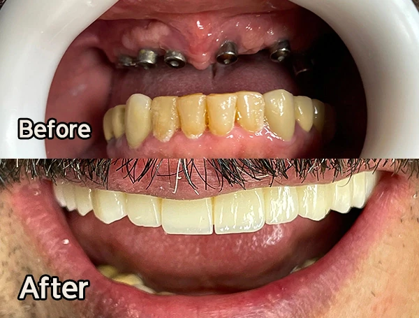 ایمپلنت-در-تهران--دندانپزشکی-میلان