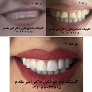 دندانپزشک-ملاصدرا-دکتر-امیر-مقدم-02188032805-لامینیت-دندان-ایمپلنت