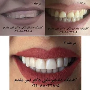 دندانپزشک ملاصدرا دکتر امیر مقدم  02188032805 لامینیت دندان،ایمپلنت