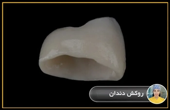  انواع روکش های زیبایی دندان