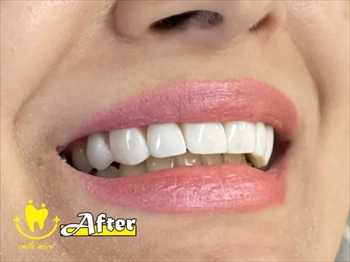 قیمت لمینت دندان در تهران