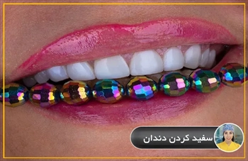 انواع روش های سفید کردن دندان چیست؟