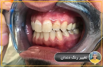 تغيير رنگ دندان تهران