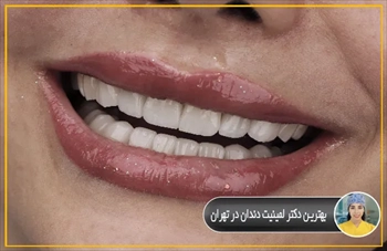 بهترین دکتر لمینیت دندان در تهران