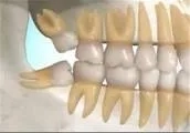 مولاژ دندان دائمی
