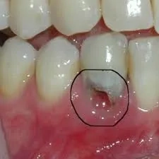 مولاژدندان باعفونت در داخل دندان