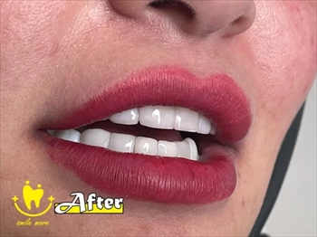 لمینت دندان با بیمه در تهران