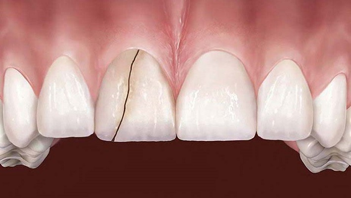 10 علت اصلی شکستن دندان چیست (2024)